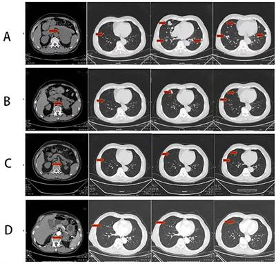 Etoposide, cisplatin, and sintilimab combined with anlotinib in successful treatment of adrenocortical carcinoma with lung metastasis: a case report